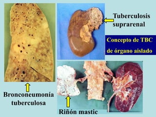 Riñón mastic
Tuberculosis
suprarenal
Bronconeumonía
tuberculosa
Concepto de TBC
de órgano aislado
 