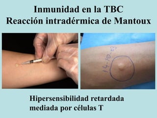 Inmunidad en la TBC
Reacción intradérmica de Mantoux
Hipersensibilidad retardada
mediada por células T
 