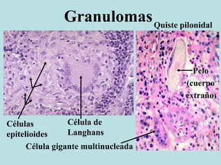 Granulomas
Células
epitelioides
Célula de
Langhans
Pelo
(cuerpo
extraño)
Célula gigante multinucleada
Quiste pilonidal
 