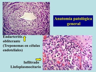 Anatomía patológica
general
Endarteritis
obliterante
(Treponemas en células
endoteliales)
Infiltrado
Linfoplasmocitario
 