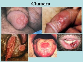Chancro
 
