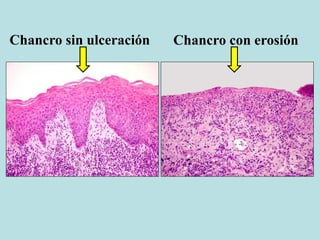 Chancro con erosiónChancro sin ulceración
 