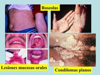 Roseolas
Lesiones mucosas orales
Condilomas planos
 