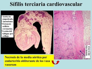 Sífilis terciaria cardiovascular
Necrosis de la media aórtica por
endarteritis obliterante de los vasa
vasorum
 