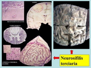 Neurosífilis
terciaria
 
