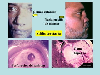 Gomas cutáneos
Nariz en silla
de montar
Perforación del paladar
Goma
hepático
Sífilis terciaria
 