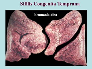 Sifilis Congenita Temprana
Neumonía alba
 