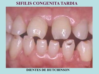 SIFILIS CONGENITA TARDIA
DIENTES DE HUTCHINSON
 