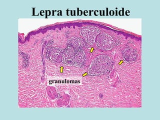 Lepra tuberculoide
granulomas
 