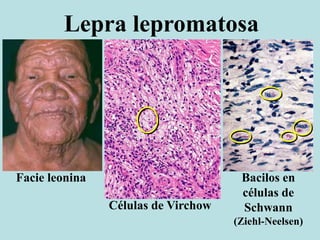 Lepra lepromatosa
Facie leonina
Células de Virchow
Bacilos en
células de
Schwann
(Ziehl-Neelsen)
 