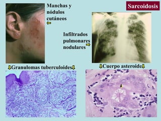 Manchas y
nódulos
cutáneos
Infiltrados
pulmonares
nodulares
Granulomas tuberculoides Cuerpo asteroide
Sarcoidosis
 