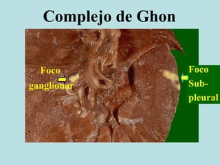 Complejo de Ghon
Foco
Sub-
pleural
Foco
ganglionar
 