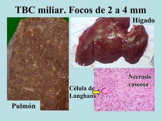 TBC miliar. Focos de 2 a 4 mm
Pulmón
Hígado
Necrosis
caseosa
Célula de
Langhans
 