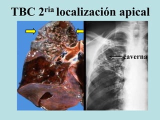 TBC 2ria localización apical
caverna
 
