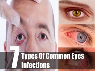 7 types of common eyes infections