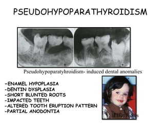 PSEUDOHYPOPARATHYROIDISM
Pseudohypoparatyhroidism- induced dental anomalies
-ENAMEL HYPOPLASIA
-DENTIN DYSPLASIA
-SHORT BLUNTED ROOTS
-IMPACTED TEETH
-ALTERED TOOTH ERUPTION PATTERN
-PARTIAL ANODONTIA
Elfin facies
 