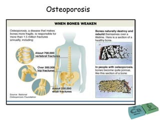 Osteoporosis
 