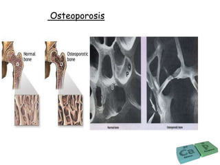 Osteoporosis
 