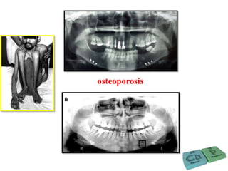 osteoporosis
 