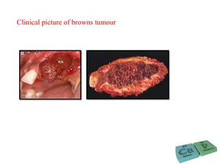 Clinical picture of browns tumour
 