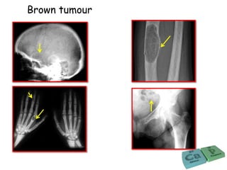 Brown tumour
 