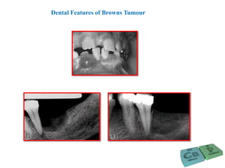 Dental Features of Browns Tumour
 