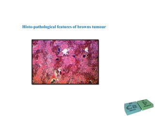 Histo-pathological features of browns tumour
 