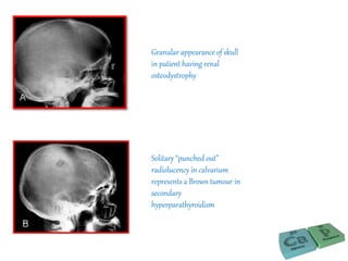 Granular appearance of skull
in patient having renal
osteodystrophy
Solitary “punched out”
radiolucency in calvarium
represents a Brown tumour in
secondary
hyperparathyroidism
 