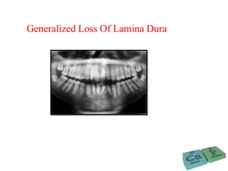 Generalized Loss Of Lamina Dura
 