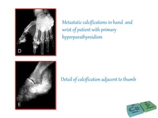 Metastatic calcifications in hand and
wrist of patient with primary
hyperparathyroidism
Detail of calcification adjacent to thumb
 