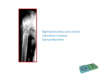 Right humerus shows coarse internal
trabeculation in primary
hyperparathyroidism
 