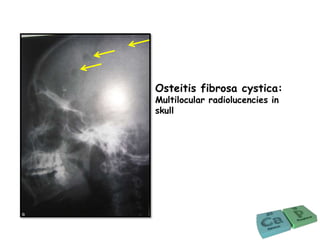Osteitis fibrosa cystica:
Multilocular radiolucencies in
skull
 