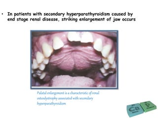 • In patients with secondary hyperparathyroidism caused by
end stage renal disease, striking enlargement of jaw occurs
Palatal enlargement is a characteristic of renal
osteodystrophy associated with secondary
hyperparathyroidism
 