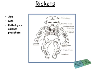 Rickets
• Age
• Site
• Pathology -
calcium
phosphate
 