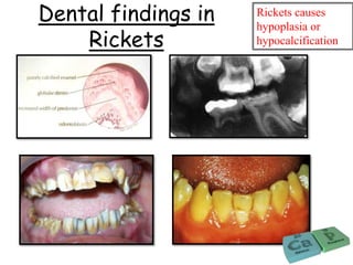 Dental findings in
Rickets
Rickets causes
hypoplasia or
hypocalcification
 