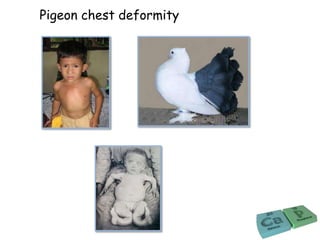 Pigeon chest deformity
 