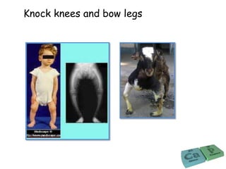 Knock knees and bow legs
 