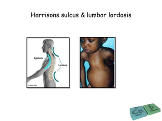 Harrisons sulcus & lumbar lordosis
 