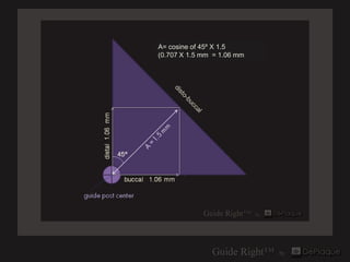 A= cosine of 45º X 1.5
(0.707 X 1.5 mm = 1.06 mm
 