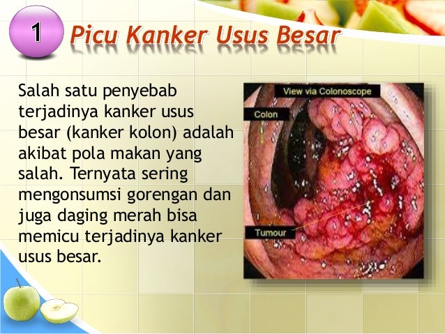 Seminar Kesehatan Bahaya Makanan Gorengan Bagi Kesehatan