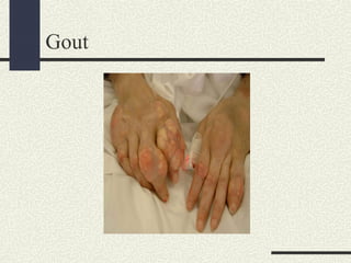 Gout
 
