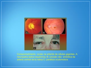 Comprometimento ocular na arteritis de células gigantes. A:
neuropatía óptica isquémica; B: oclusão não embólica da
arteria central de la retina C: parálisia oculomotora
 