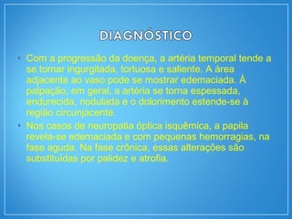 • Com a progressão da doença, a artéria temporal tende a
se tornar ingurgitada, tortuosa e saliente. A área
adjacente ao vaso pode se mostrar edemaciada. À
palpação, em geral, a artéria se torna espessada,
endurecida, nodulada e o dolorimento estende-se à
região circunjacente.
• Nos casos de neuropatia óptica isquêmica, a papila
revela-se edemaciada e com pequenas hemorragias, na
fase aguda. Na fase crônica, essas alterações são
substituídas por palidez e atrofia.
 