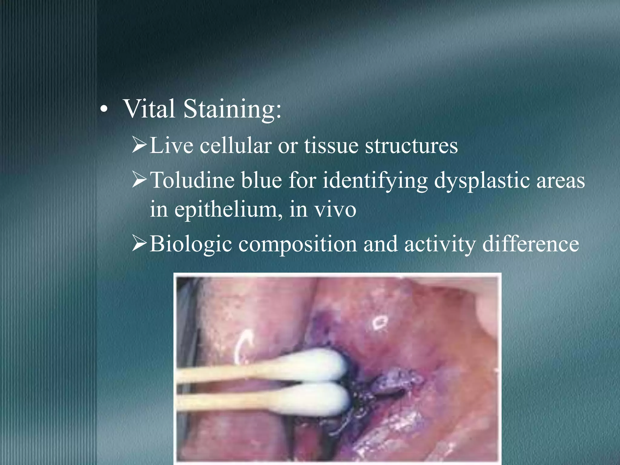 • Vital Staining:
Live cellular or tissue structures
Toludine blue for identifying dysplastic areas
in epithelium, in vivo
Biologic composition and activity difference
 