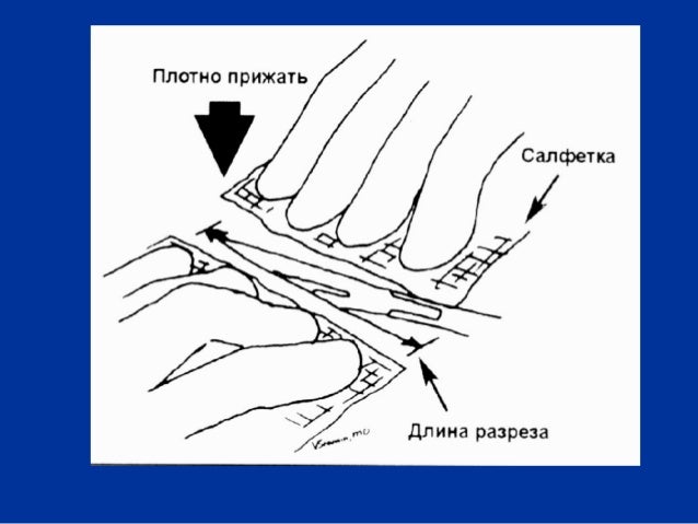 Операция на кресты