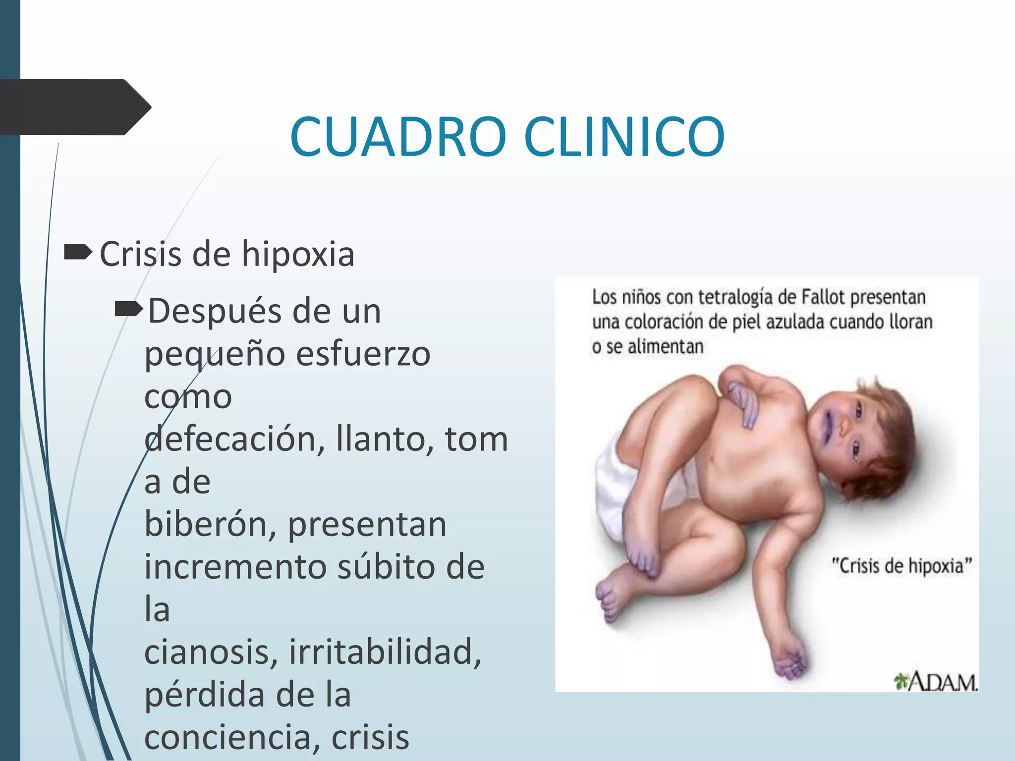 CUADRO CLINICO
Crisis de hipoxia
Después de un
pequeño esfuerzo
como
defecación, llanto, tom
a de
biberón, presentan
incremento súbito de
la
cianosis, irritabilidad,
pérdida de la
conciencia, crisis

 