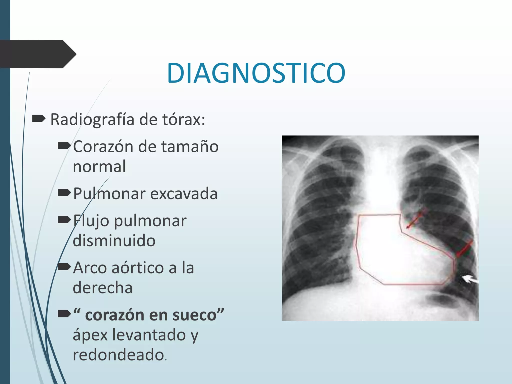 DIAGNOSTICO
 Radiografía de tórax:
Corazón de tamaño
normal
Pulmonar excavada
Flujo pulmonar
disminuido
Arco aórtico a la
derecha
“ corazón en sueco”
ápex levantado y
redondeado.

 