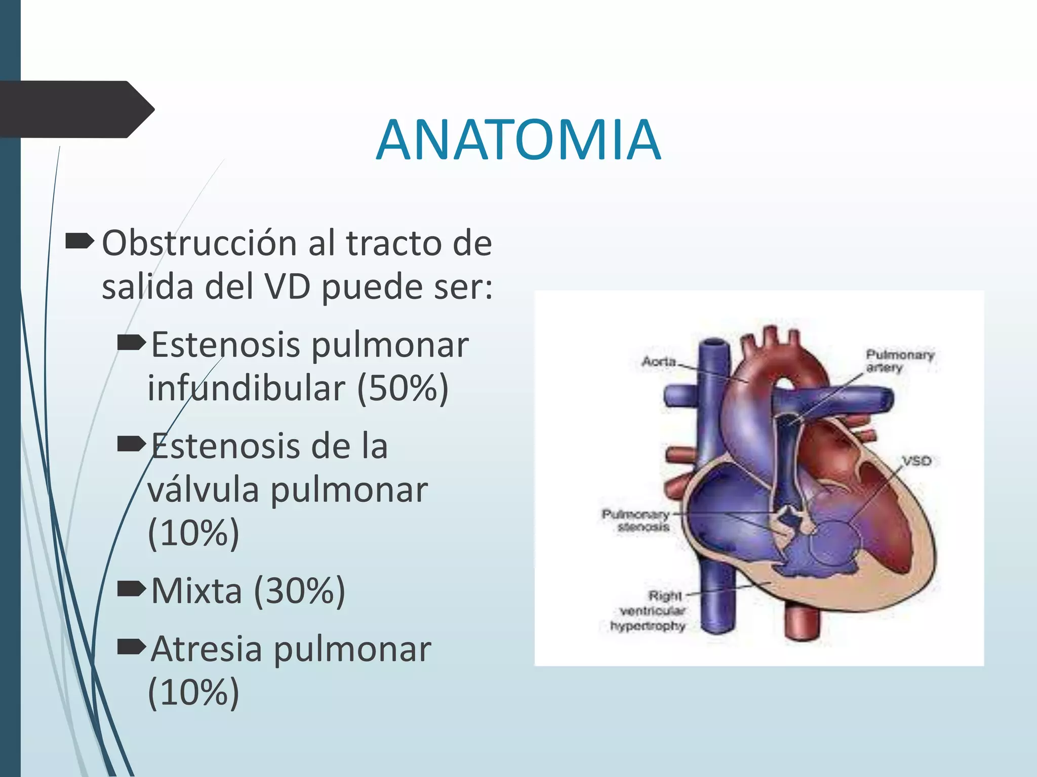 ANATOMIA
Obstrucción al tracto de
salida del VD puede ser:
Estenosis pulmonar
infundibular (50%)
Estenosis de la
válvula pulmonar
(10%)
Mixta (30%)
Atresia pulmonar
(10%)

 