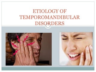 ETIOLOGY OF
TEMPOROMANDIBULAR
DISORDERS
 