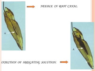 NEEDLE IN ROOT CANAL.
INJECTION OF IRRIGATING SOLUTION. 16
 